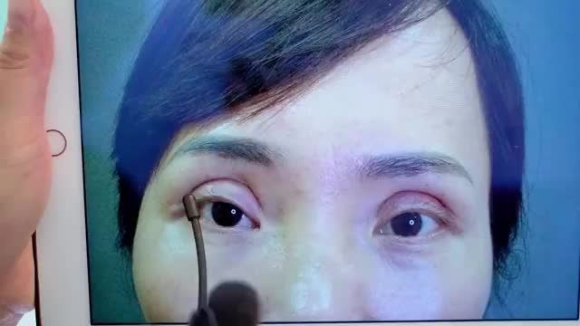 Sửa mí hỏng nặng DeepTech Med trong thời điểm vàng 0-14 ngày cho vị khách hàng lỡ làm mí biến chứng hỏng tại cơ sở thiếu uy tín