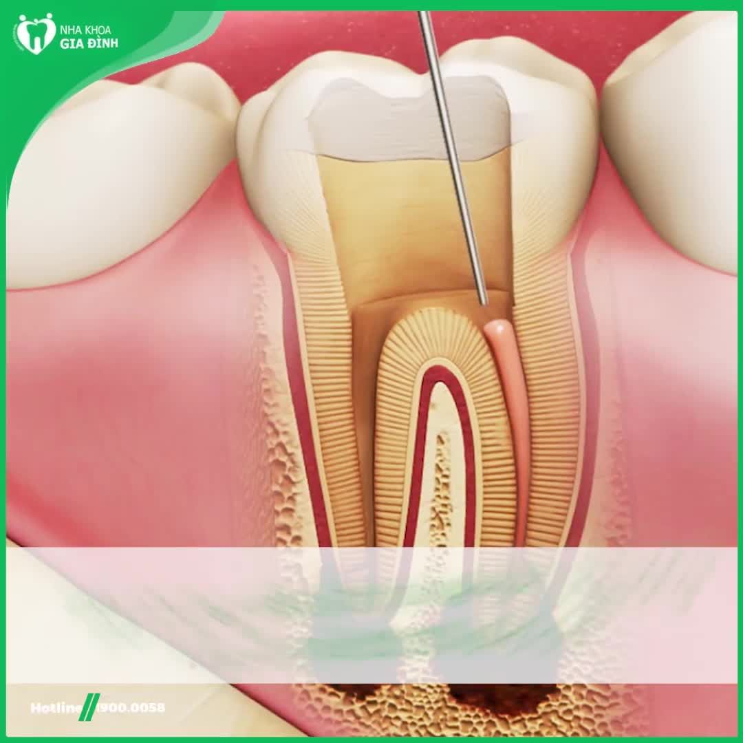 TẠI SAO PHẢI BỌC RĂNG SỨ SAU KHI ĐIỀU TRỊ TỦY