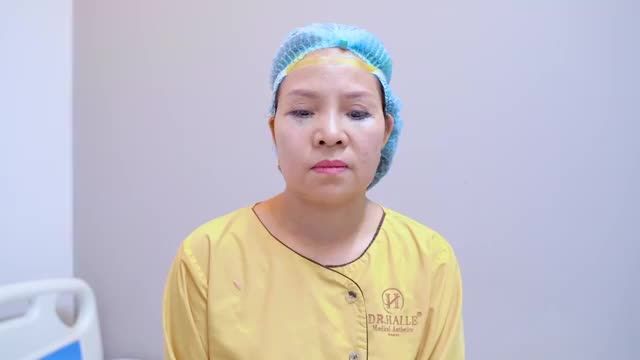 Tạo hình mí dưới xóa bỏ rãnh lệ gây chùng nhão mí dưới thành công như thế nào?