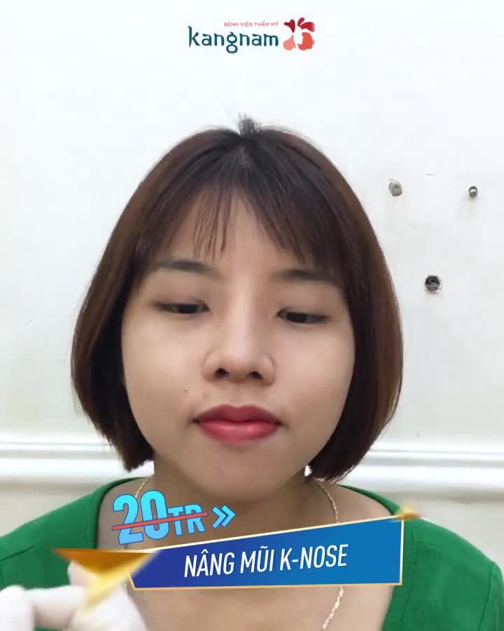 THÁNG 4 TRI ÂN - NÂNG MŨI chỉ từ 14 Triệu