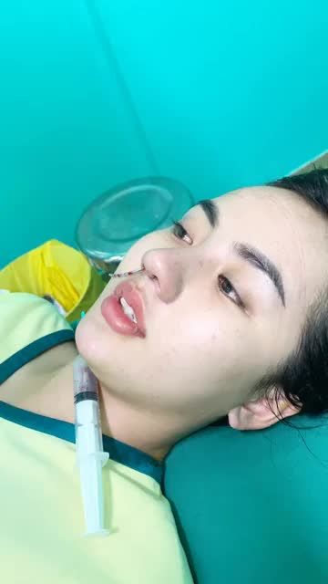 THÀNH QUẢ SAU NÂNG MŨI CẤU TRÚC