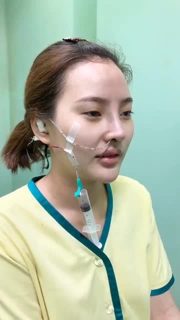 THÀNH QUẢ SAU NÂNG MŨI CẤU TRÚC NANO - LÊN FORM CỰC XINH