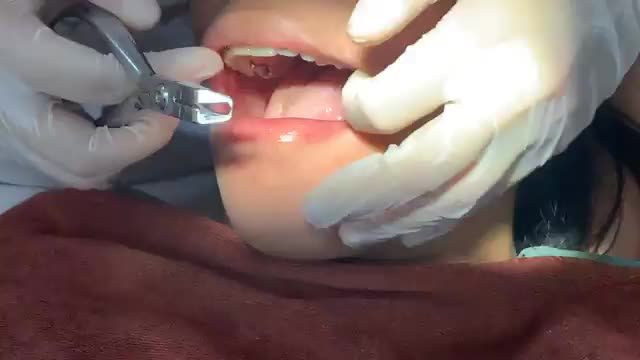 THÁO MẮC CÀI SAU 2 NĂM NIỀNG RĂNG KHẤP KHỂNH NẶNG