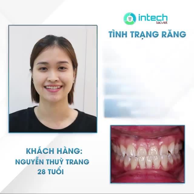 THAY ĐỔI HÀM RĂNG - THĂNG HẠNG NHAN SẮC