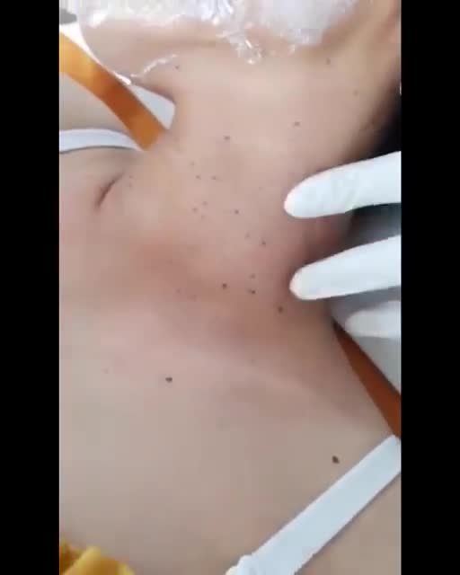 Thay đổi tuyến mồ hôi sau sinh MỤN THỊT chằng chịt ở cổ