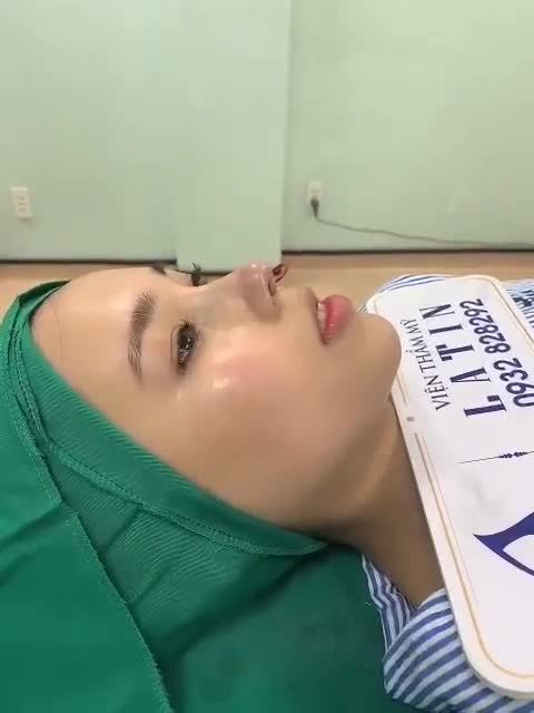 Thêm một ca mũi cấu trúc form nhẹ nhàng tự nhiên nhà Latin để khách hàng tham khảo.