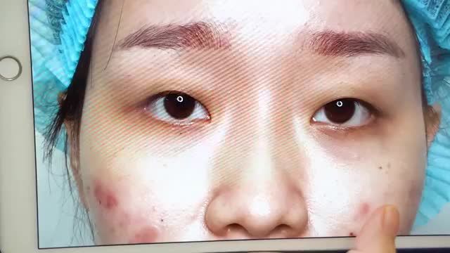 Thổi hồn vào đổi mắt cho nàng thêm tự tin cá tín nhờ tiêu phẫu cắt mí đơn giản.