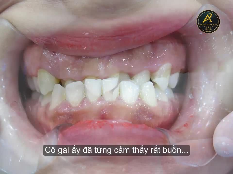 Thường thì chỉ hai ngày khách hàng đã có một hàm răng mới, nụ cười mới