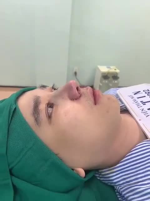 Tiếp tục 1 ca mũi cho bạn nam, thực hiện nâng mũi nâng mũi bán cấu trúc, thu nền xương, chỉnh gồ, cuốn cánh mũi.