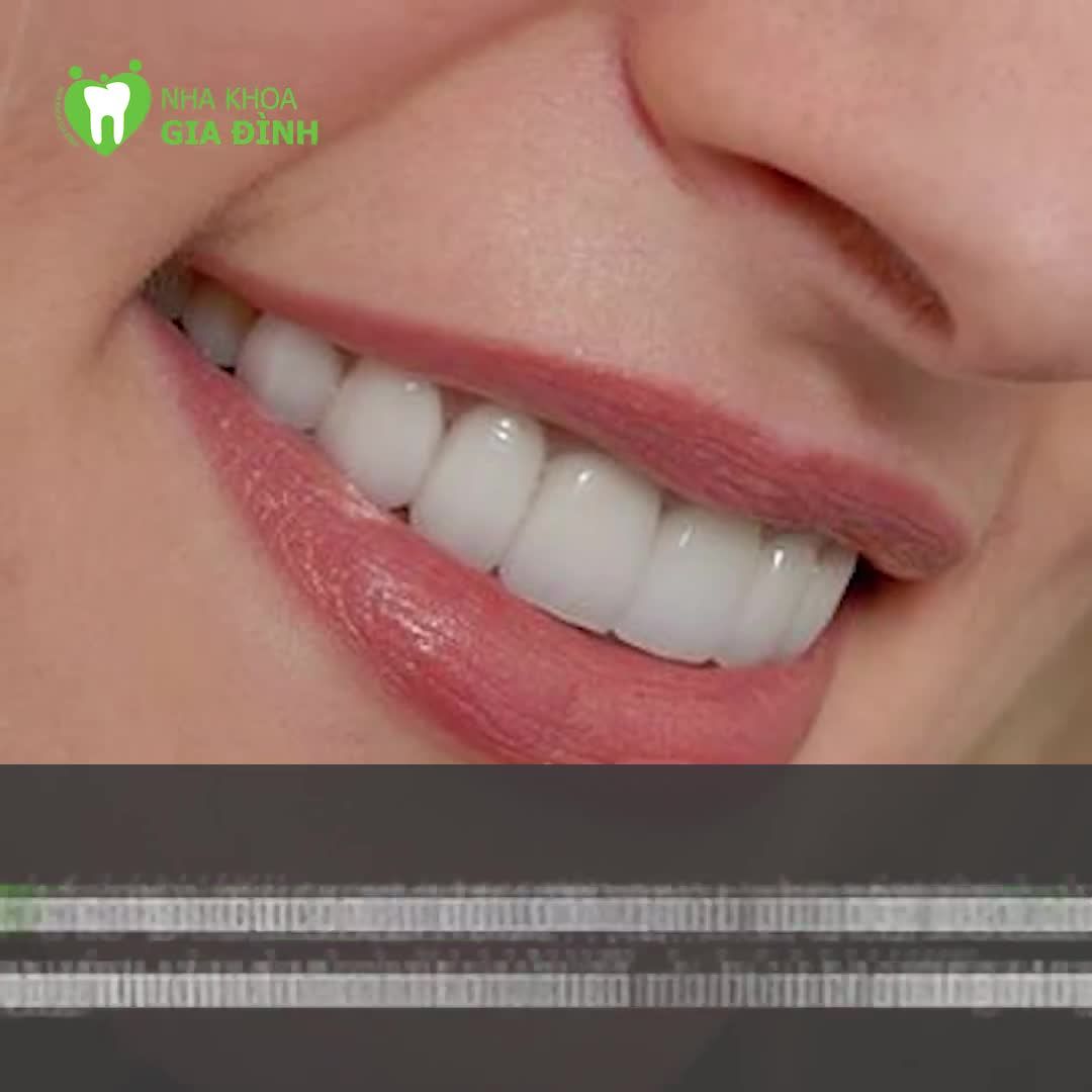 TIÊU CHUẨN VỀ MỘT HÀM RĂNG ĐẸP