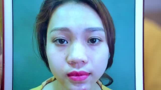 Tiểu phẫu nhỏ hạnh phúc to Mời quý khách hàng cùng chiêm ngưỡng nếp mí vừa thực hiện xong đẹp vô cùng hài hòa rạng rỡ