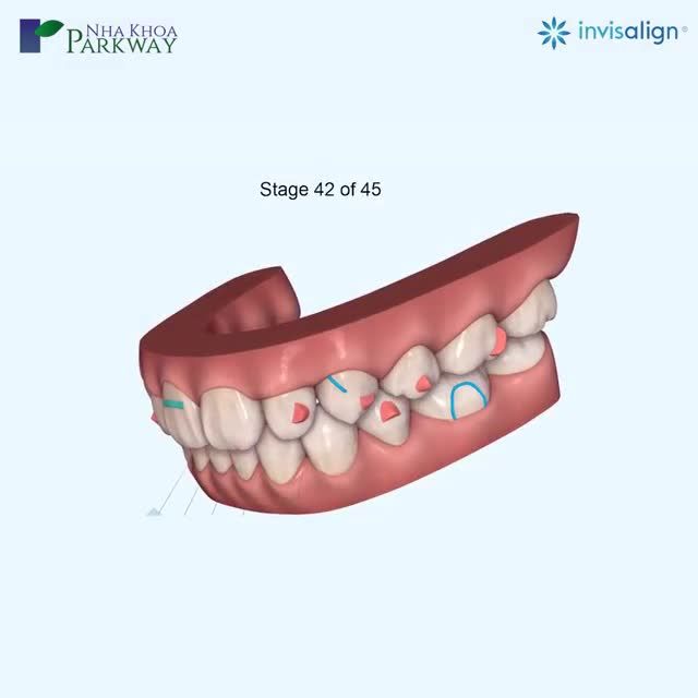 TÌM LẠI SỰ TỰ TIN TRONG GIAO TIẾP VỚI NIỀNG RĂNG INVISALIGN