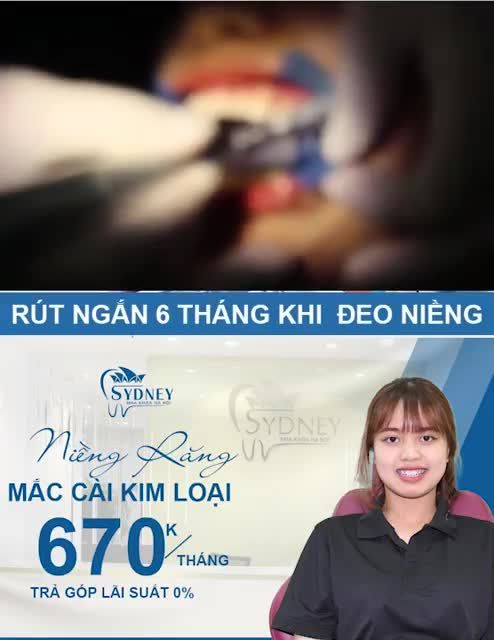 TIPS GIÚP BẠN TIẾT KIỆM CHI PHÍ NIỀNG RĂNG