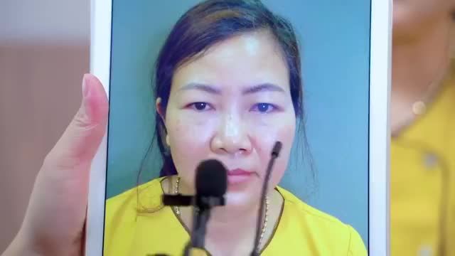 Trả lại tuổi thanh xuân cho khách hàng chỉ sau 45 phút thực hiện tiểu phẫu Nâng cung mày