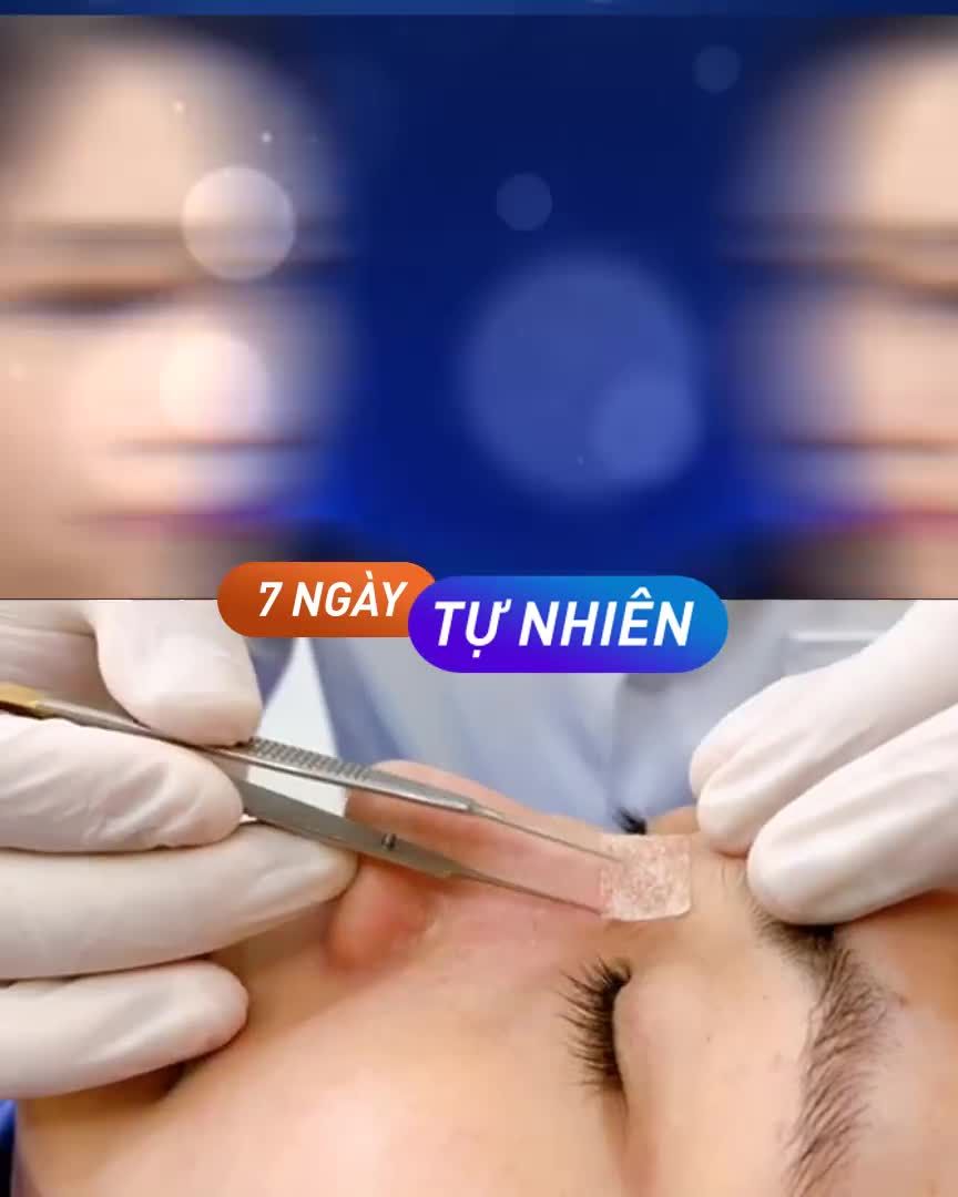 Trend là nhất thời - NÂNG MŨI CẤU TRÚC 4D là mãi mãi