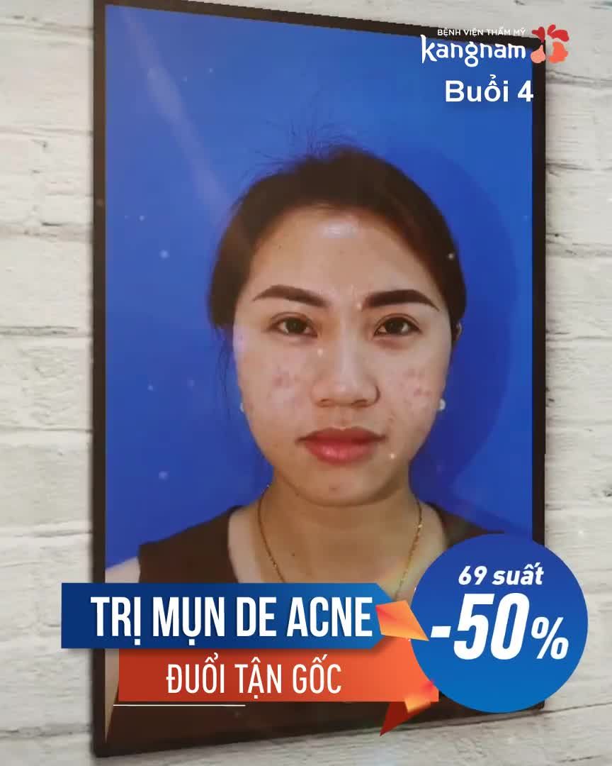 TRỊ MỤN - ĐÃ ĐUỔI LÀ ĐUỔI TẬN GỐC