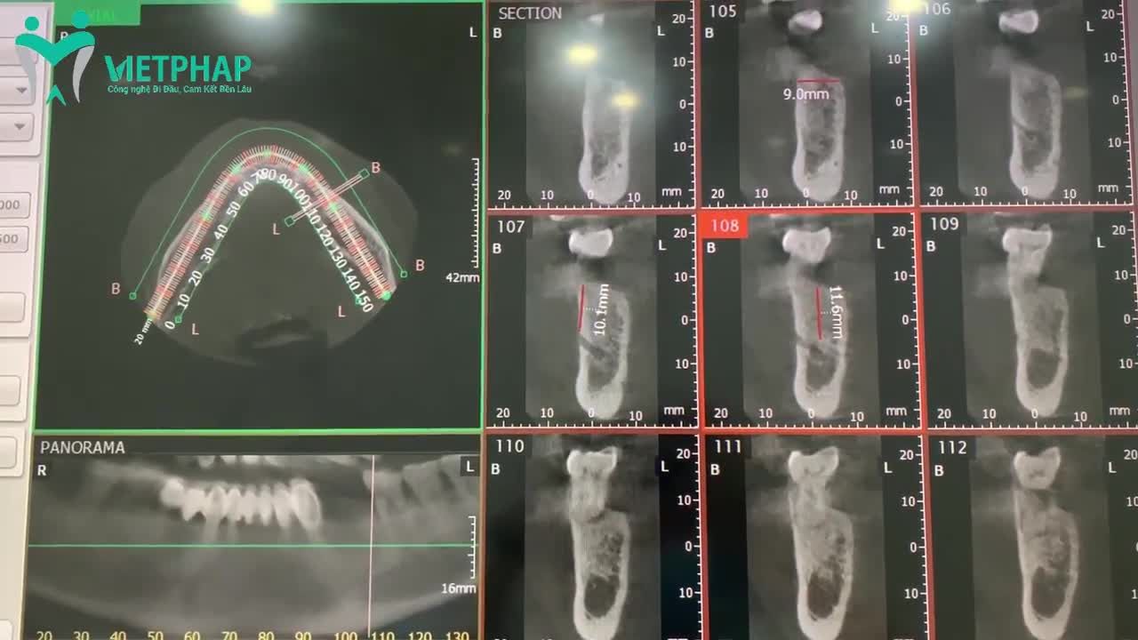 TRỒNG 2 RĂNG IMPLANT - TRẢI NGHIỆM THỰC TẾ TỪ KHÁCH HÀNG