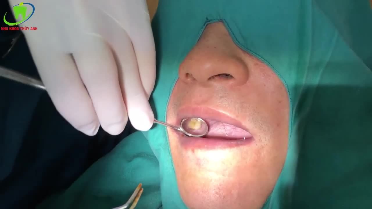 TRỒNG IMPLANT CÓ NÂNG XOANG KÍN THAY THẾ RĂNG 16 ĐÃ MẤT CHO KHÁCH HÀNG