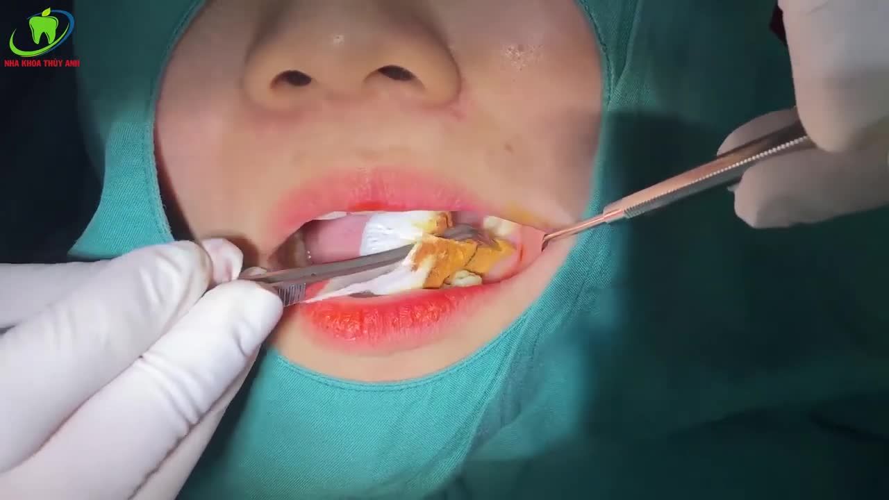 TRỒNG RĂNG IMPLANT KỸ THUẬT FLAPLESS KHÔNG ĐAU KHÔNG CHẢY MÁU