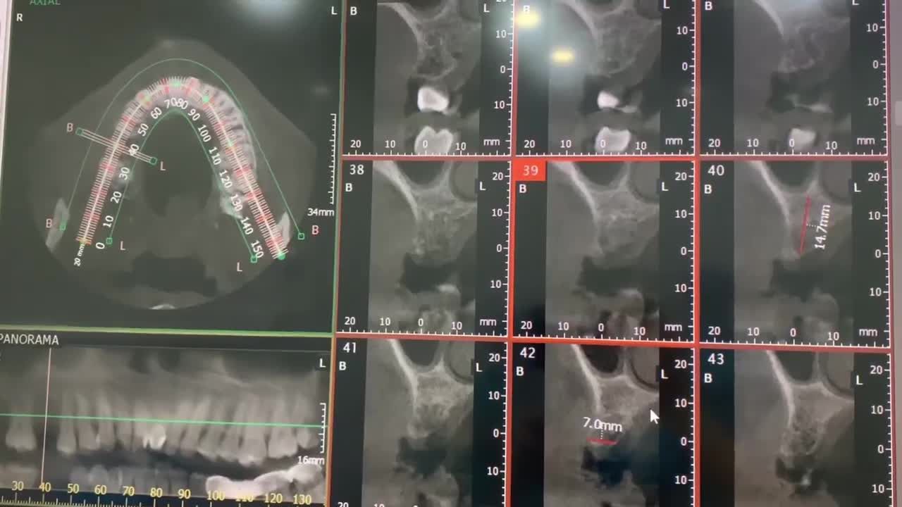 TRỒNG RĂNG IMPLANT - ƯU ĐIỂM VƯỢT TRỘI PHỤC HỒI RĂNG MẤT
