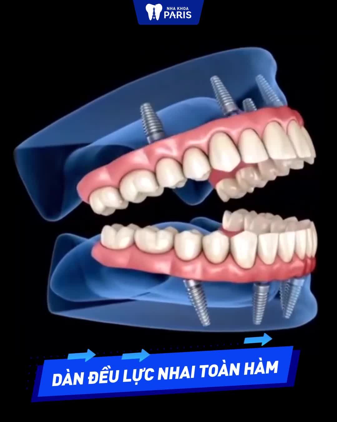 Trồng răng toàn hàm bền trọn đời
