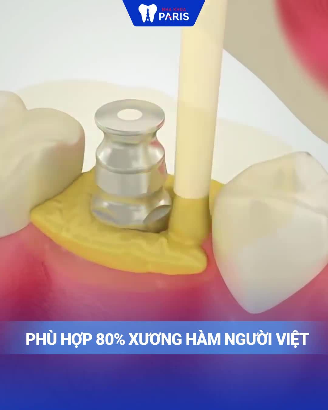 TRỒNG RĂNG TRỌN GÓI CHỈ 8.8 TRIỆU