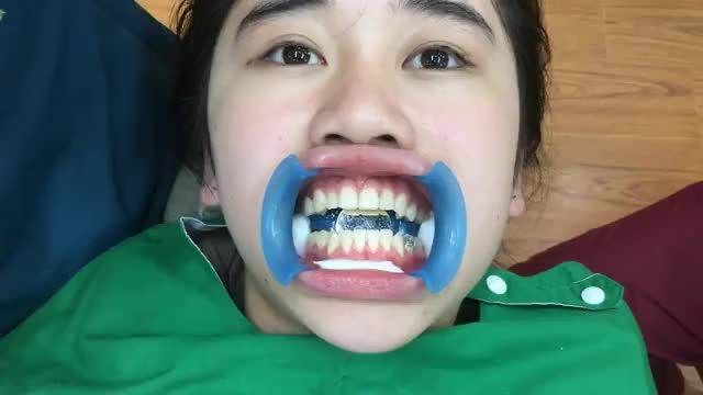 TRỰC TIẾP GẮN MẮC CÀI TẠI NHA KHOA THÙY ANH.