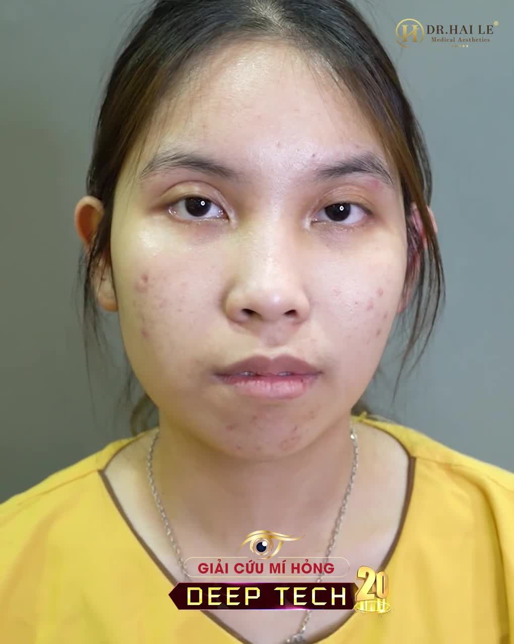 Trước khi bước vào phòng mổ, cô nàng ấy đã ôm mẹ và khóc -Con sợ lắm mẹ ơi! -Lần sửa mí này là hi vọng cuối cùng của con ---Và giọt nước mắt đầy lo lắng của người mẹ