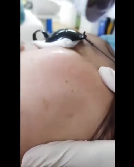 Virus HPV gây ra MỤN THỊT - không can thiệp kịp thời LAN RỘNG toàn mặt