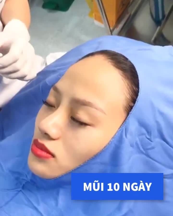 WOW! Mũi cắt chỉ sau 10 ngày đẹp xuất sắc Nâng mũi xong chỉ có xinh lên thôi!
