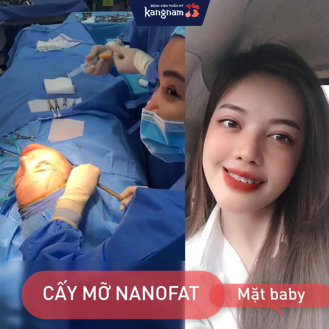 Woww! Kết quả 1 tháng sau Cấy mỡ mặt Nanofat - Mọi người thấy thế nào ạ?