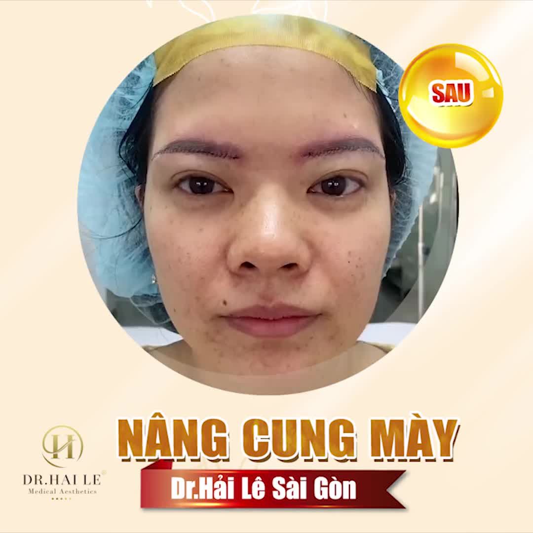 45 phút trước KH nói mí mắt sụp hết cả rồi, da chùng, mỡ thừa khiến đôi mắt u buồn