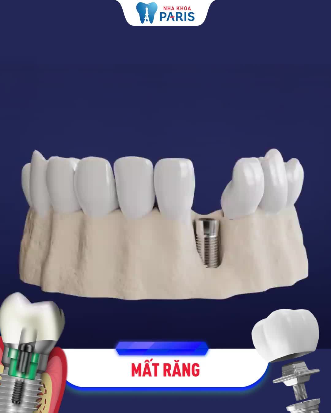 ĂN NHAI TRỌN ĐỜI VỚI TRỒNG RĂNG IMPLANT