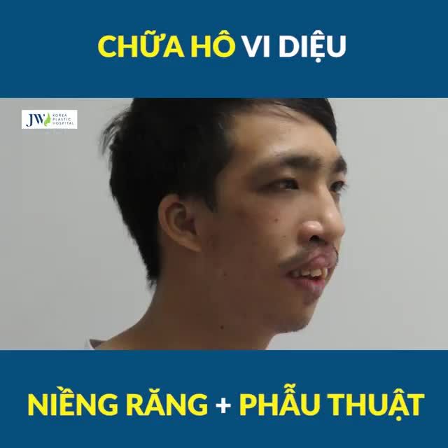 Bái bai HÀM MÓM nhờ NIỀNG RĂNG - Kết quả ĐỈNH CỦA ĐỈNH