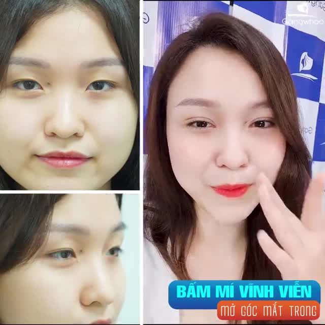 BẤM MÍ, CẮT MÍ CÓ THẬT SỰ ĐAU NHƯ LỜI ĐỒN???