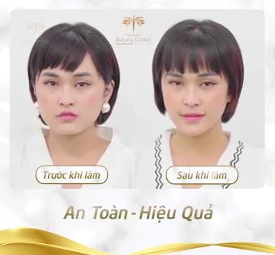 Botox Pháp tại Tấm thần kì thế nào