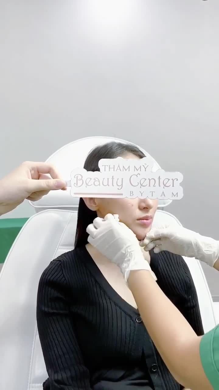 Botox thon gọn hàm cho chị khách hàng có gương mặt nhỏ nhưng phần hàm bị cơ cứng, to bạnh, mất cân đối, to nhiều về bên trái.