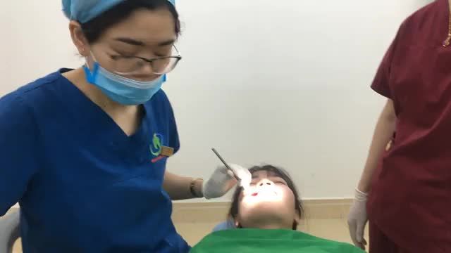 ca cấy minivit hàm trên cho bạn khách hàng chỉnh nha tại Nha Khoa Thuỳ Anh kéo giảm hô.
