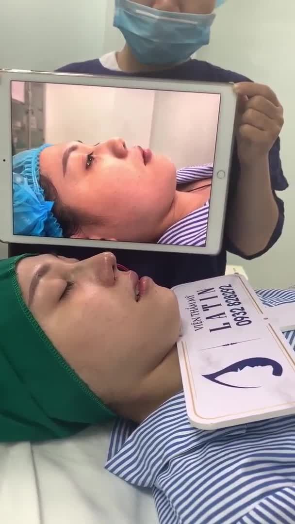 Ca mũi bán cấu trúc thu nền xương, chỉnh gồ, thu đầu mũi và cánh mũi vừa hoàn thiện xong.