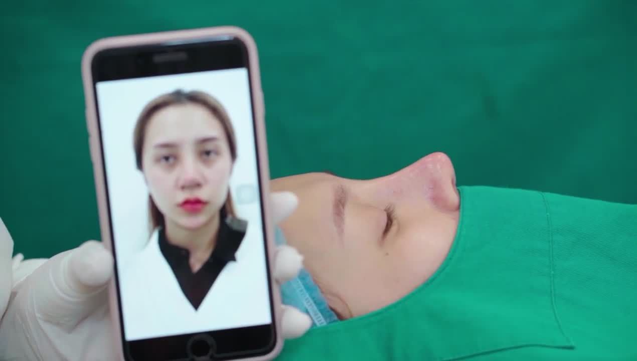 Ca nâng mũi Surgiform cho bạn khách hàng. Khắc phục được hoàn toàn các nhược điểm của chiếc mũi cũ và mang lại dáng mũi cao tây đầy thu hút.