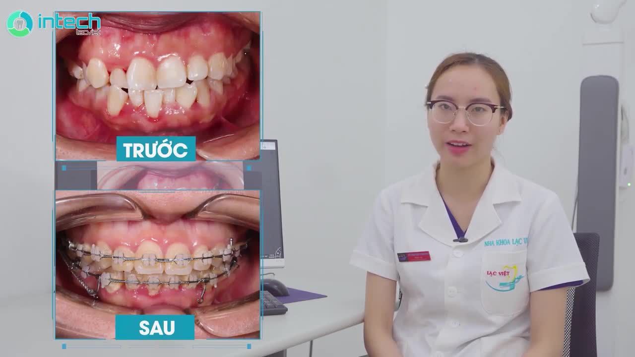 CA NIỀNG RĂNG HÔ, KHẤP KHỂNH CÓ RĂNG 7 ĐỔ