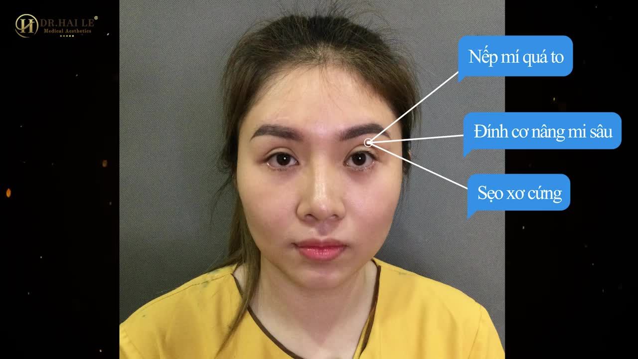 "Các bạn cắt mí lỡ mà bị hỏng như em thì cứ đến Dr.Hải Lê, đừng sửa tùm lum tà la không đúng cách như em rồi hỏng nhiều lần, chữa mãi không lành được..."