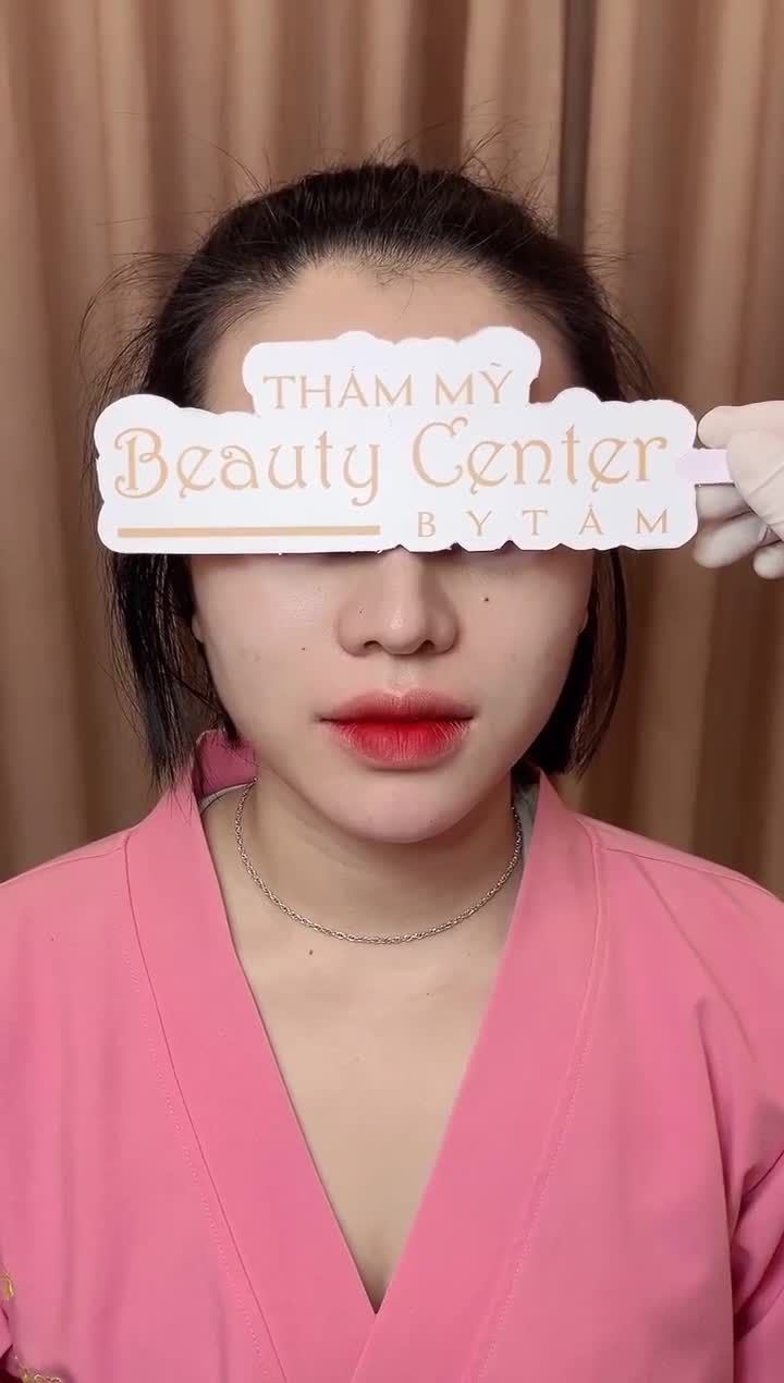 Cằm tròn đầy phú quý cho bạn khách hàng có cằm ngắn, lẹm. So sánh hình ảnh trước làm và ngay sau làm để thấy rõ sự khác biệt!