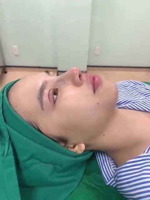 Cận cảnh combo Mũi bán cấu trúc + Mí 4D + Tiêm filler môi + Cấy mỡ má Baby + Cấy mỡ rãnh cười ngay sau khi thực hiện.
