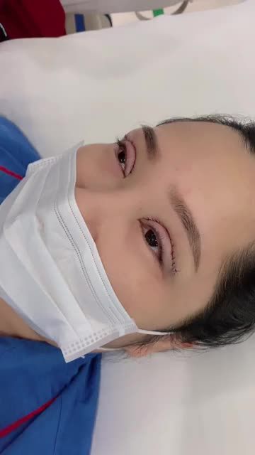 Cận cảnh kết quả ngay sau CẮT MÍ PLASMA