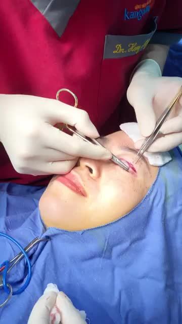 Cận cảnh QUY TRÌNH KHÂU ĐÓNG NẾP MÍ ‼️ Bác sĩ Kangnam đang TỈ MỈ những bước cuối cùng cho NẾP MÍ ĐẸP