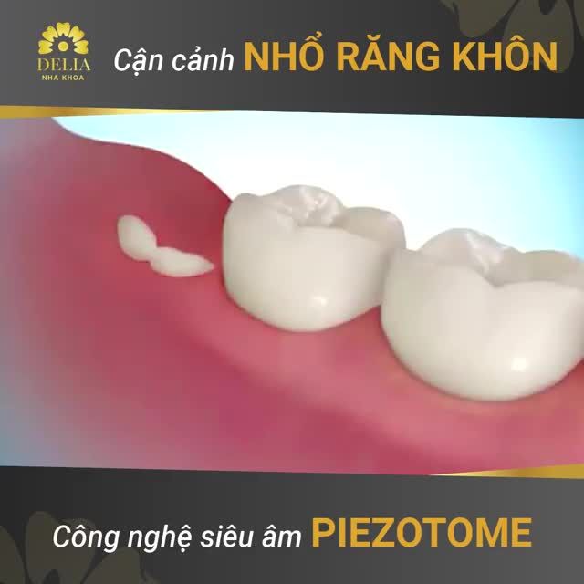 CẬN CẢNH QUY TRÌNH NHỔ RĂNG KHÔN CỰC ĐÃ MẮT