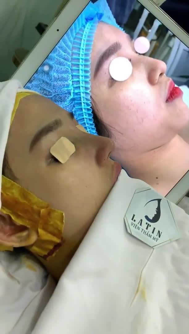 Case mũi bọc sụn thu nền xương, lót megaderm chuẩn dáng Latin vừa hoàn thành đây cả nhà ơi! Cao tây nhưng vẫn giữ được độ tự nhiên phù hợp mặt.