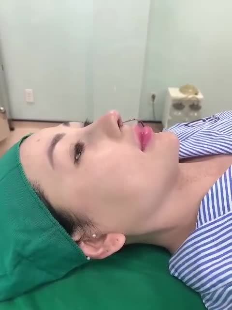 Case mũi sửa lại cấu trúc sóng surgiform dáng cao tây cho KH từ Cà Mau lên Sài Gòn làm đẹp.