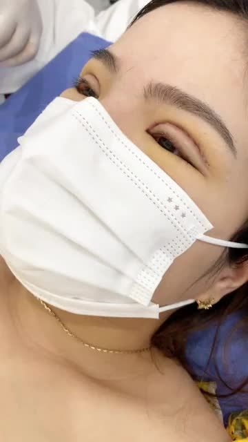 CẮT CHỈ MÍ sau 5 ngày - ĐỀU ĐẸP đến Khó tin